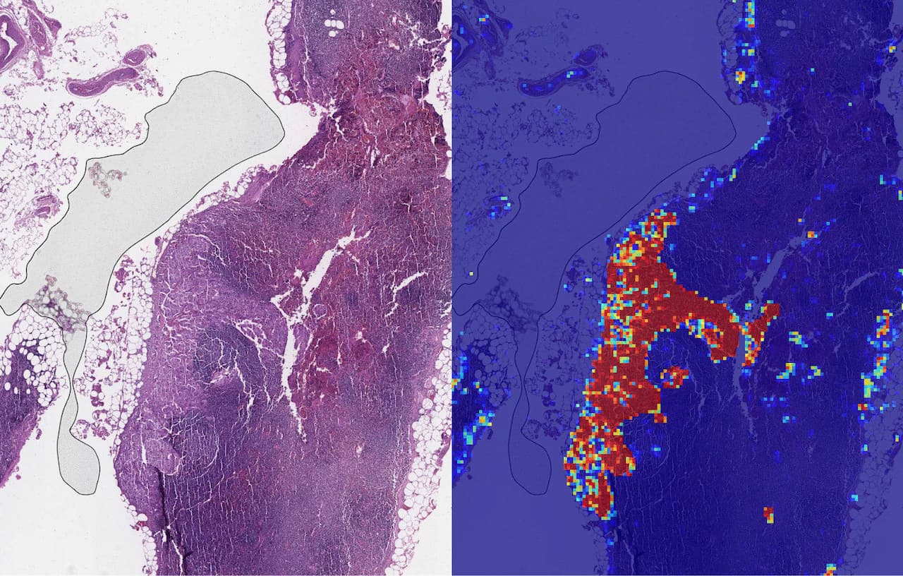 GoogleのAI「Lymph Node Assistant(LYNA)」、転移性乳がんの検出精度で99%達成と主張されている。医師は診断をスキップし患者ケアに集中可能になるかもしれない。via Google