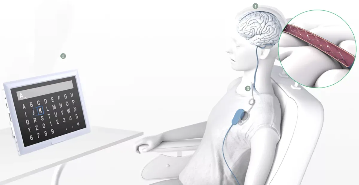 シンクロン、米国で初めて脳埋め込み装置を患者に移植  マスクのニューラルリンクに先んじる